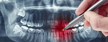 Рентгендиагностика в стоматологии